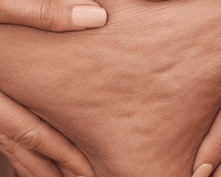 MASAJE ANTICELULÍTICO DE PIERNAS + APARATOLOGÍA