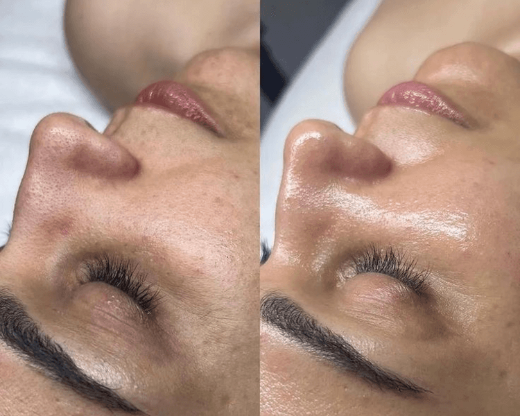Higiene profunda Facial