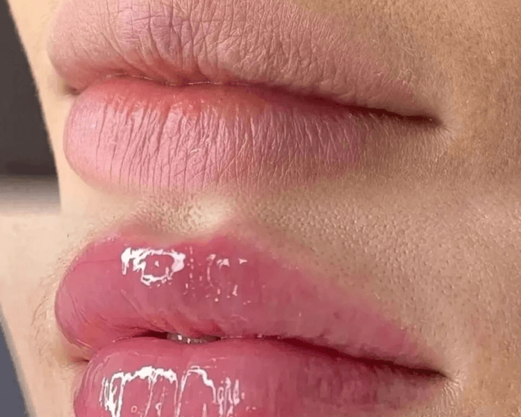 Hydra lips (labios)