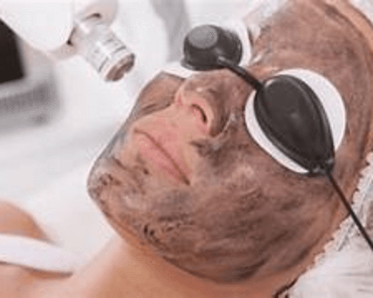 HOLLYWOD PEELING/PIEL DE PORCELANA (INCLUYE LIMPIEZA FACIAL PROFUNDA + HIDRATACION) ANTES 80000