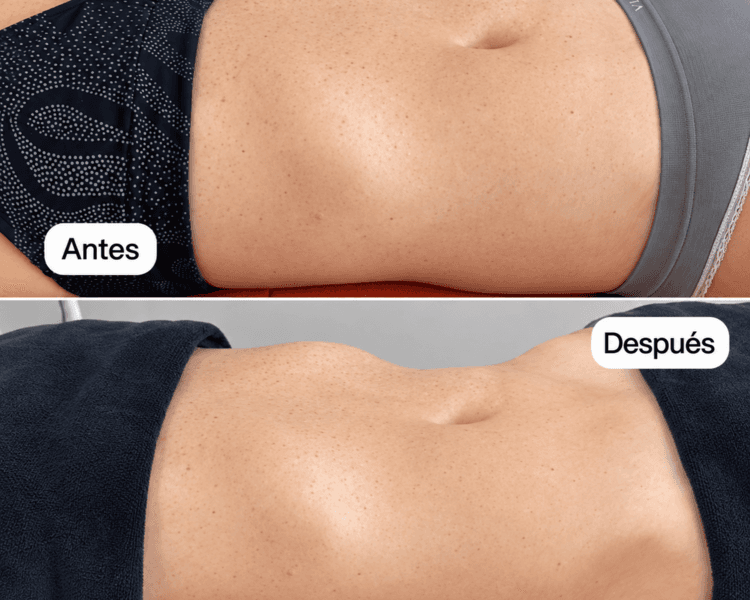 Pack 4 sesiones drenaje linfatico MAF + radiofrecuencia