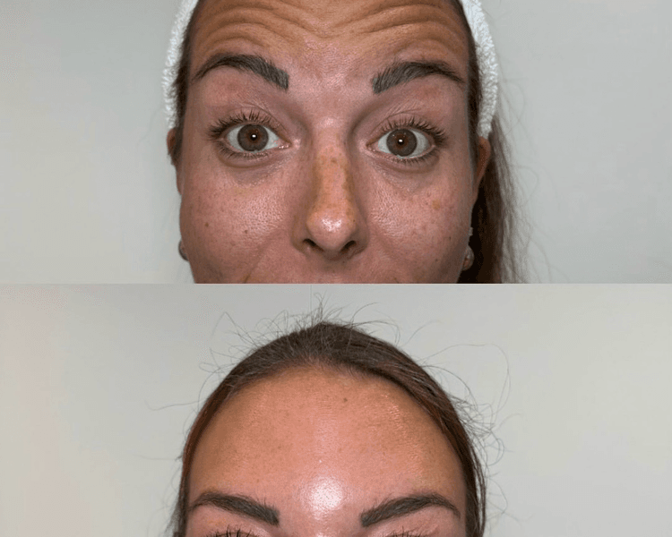 BOTOX 1 frente y entrecejo