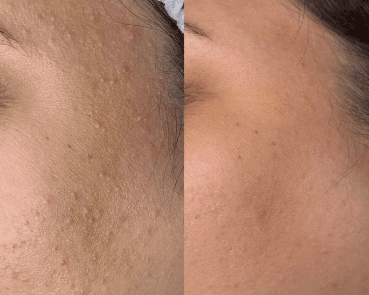 TRATAMIENTO DE ACNE
