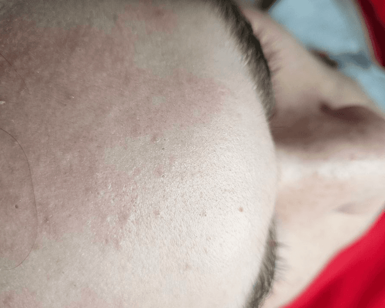 Limpieza facial TEEN