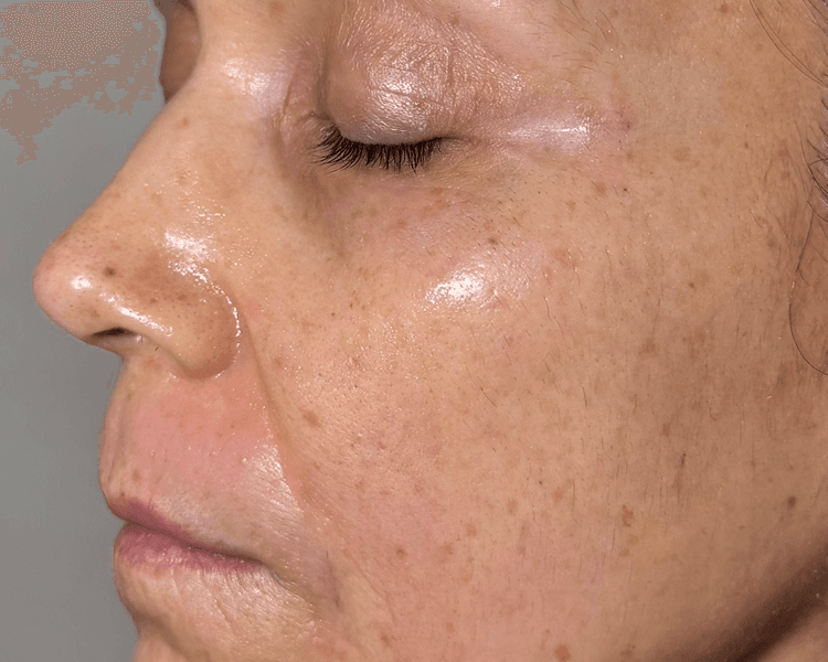 Plasma Rico En Plaquetas + Microneedling Facial