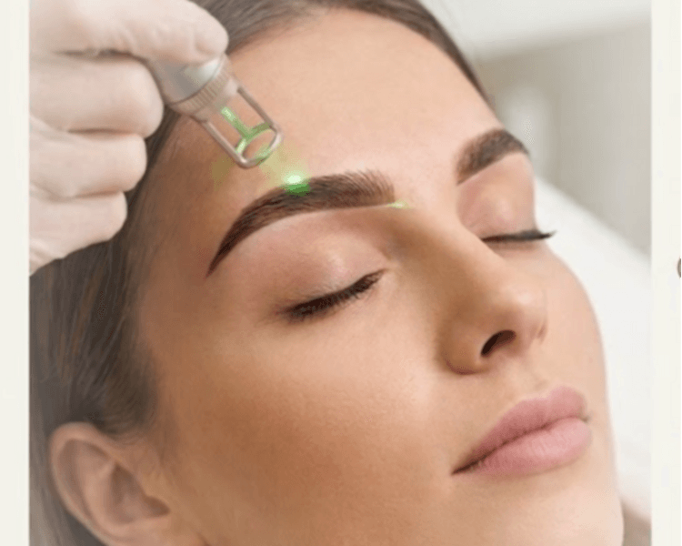 Depilación Láser EN CEJAS