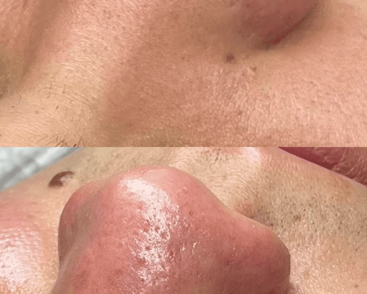 Higiene facial profunda