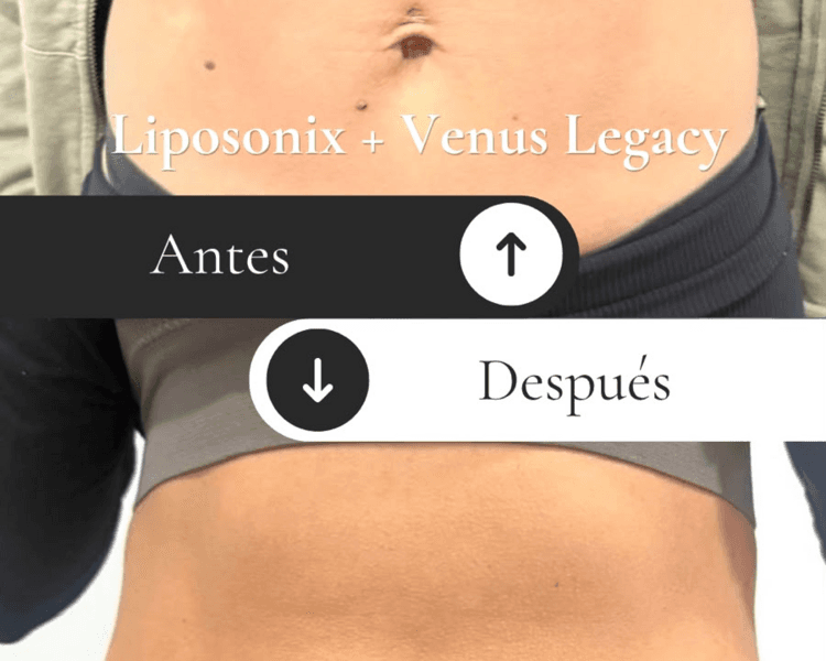 VENUS + LIPOSONIX X 4 (ABDOMEN Y FLANCOS)