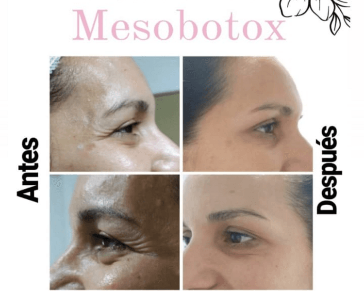 Mesobotox (consultar dia que viene la Dra.)
