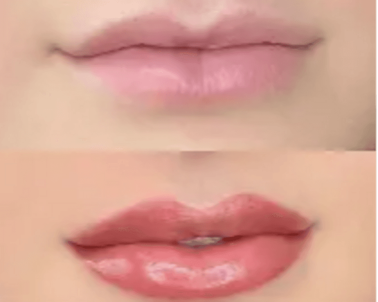 HIDRA LIPS