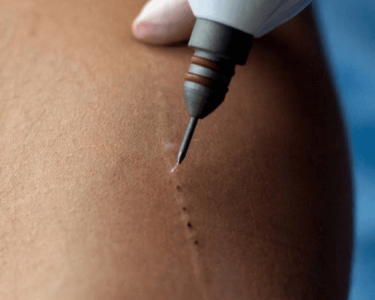 Tratamiento Estrias Plasmed
