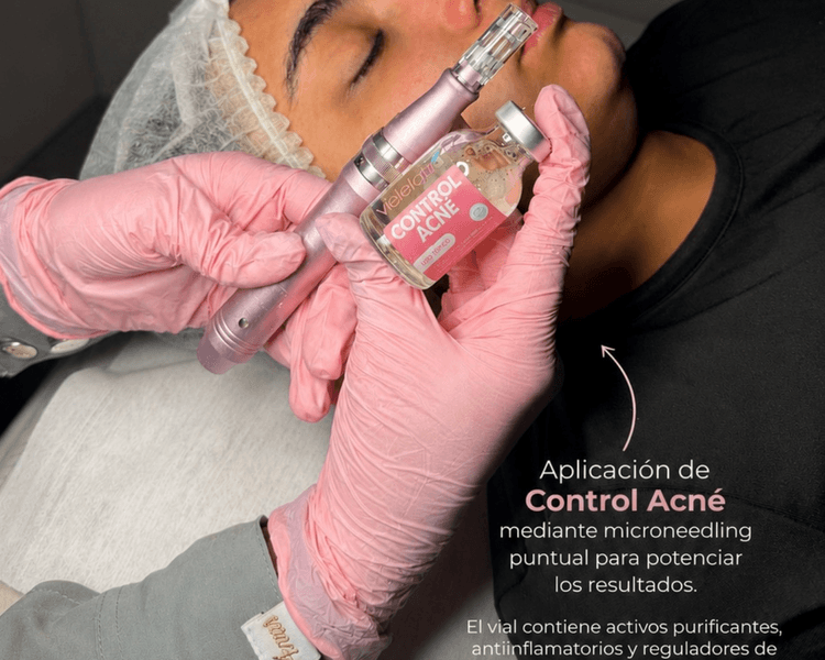 PROTOCOLO ESPECIAL ACNE