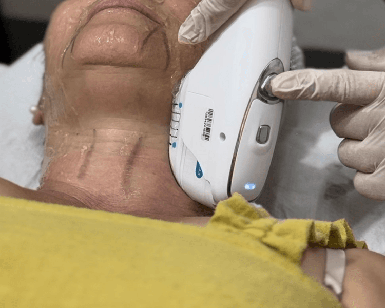 Hifu con higiene facial profunda