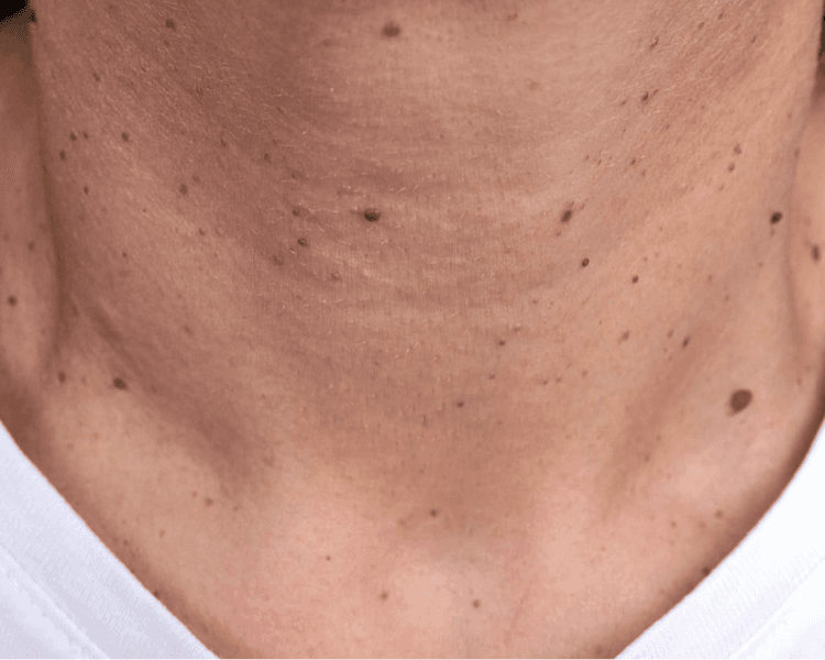 RETIRO DE ACROCORDONES, VERRUGAS, SIRINGOMAS Y/O QUISTES DE MILLIUM