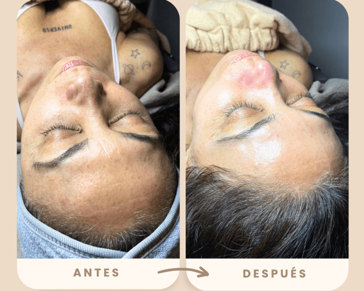 LUMIGLOW (incluye dermaplaning, dermapen y peeling para luminosidad e hidratación facial)