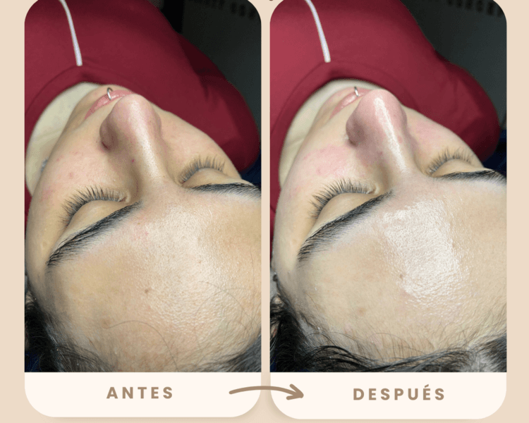 Peeling químico