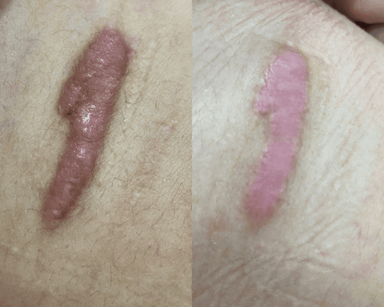 Tratamiento Cicatrices/Queloide Plasmed
