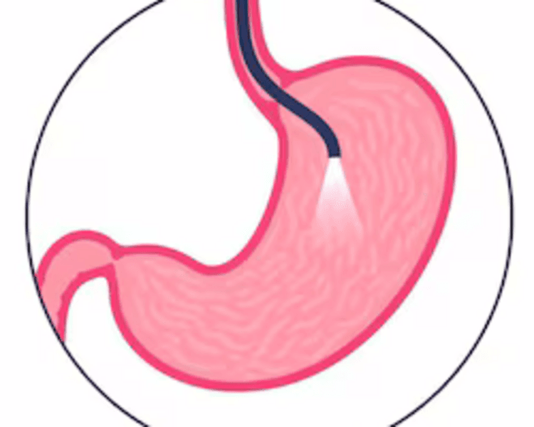 Endoscopía - Colonoscopía