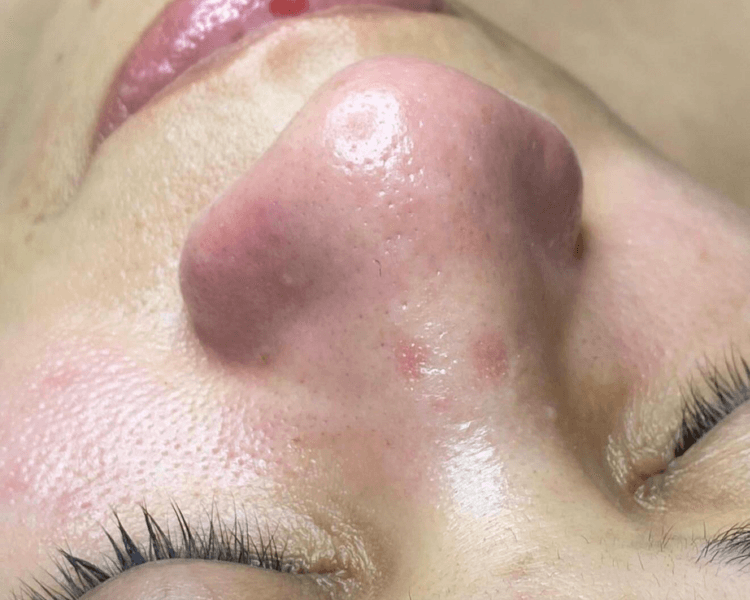 Limpieza facial profunda