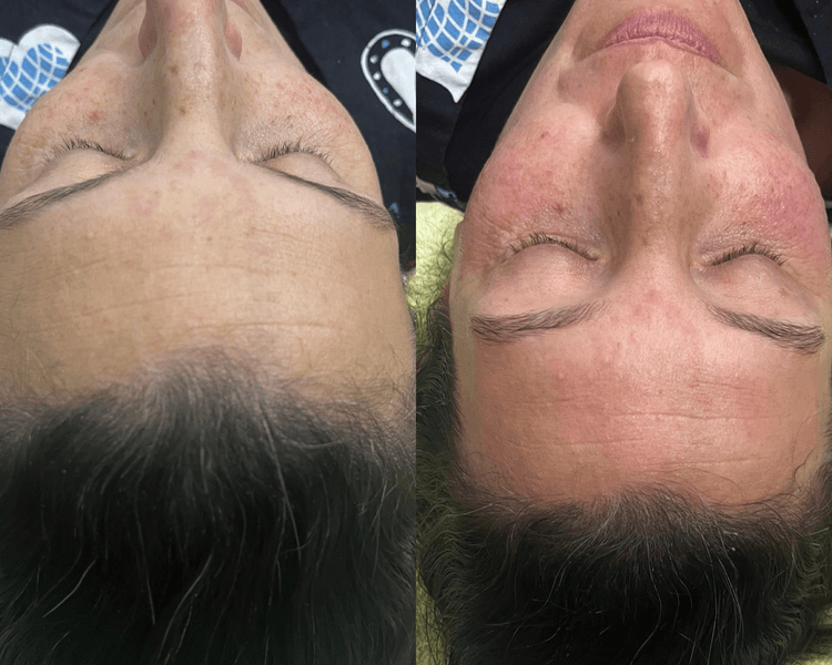 Tratamiento Especifico Limpieza pregunta incluida Acne-Rosasea-Manchas Vane