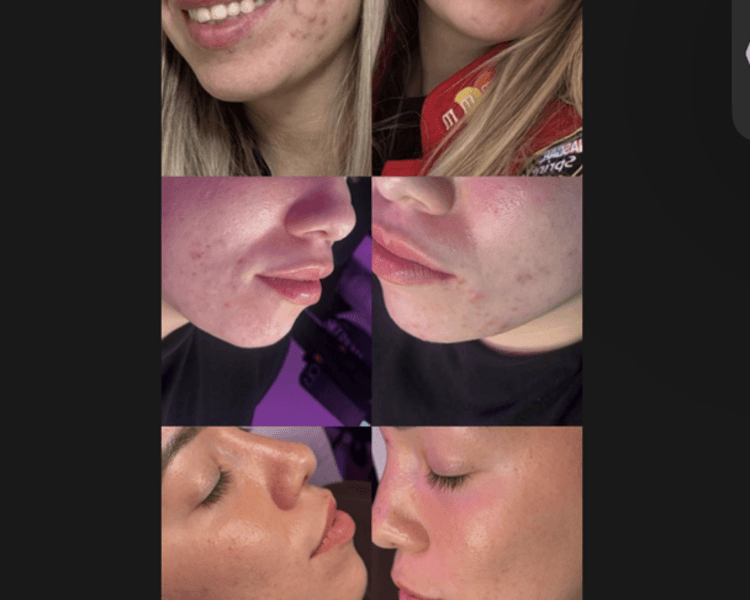 MICRONEEDLING - DERMAPEN ✨