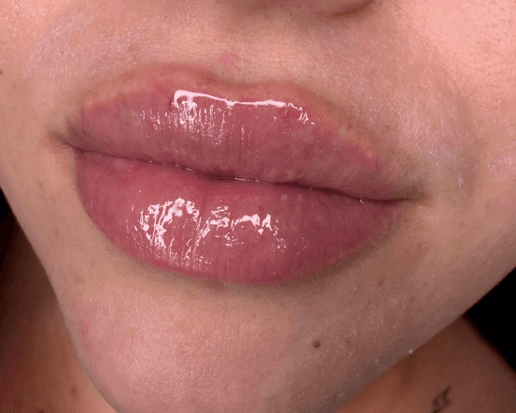 Hidralips (hidratación profunda de labios con ácido hialurónico)