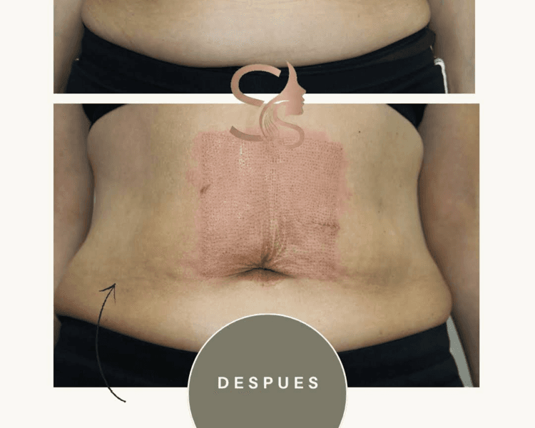 Plasmalifting ombligo alto