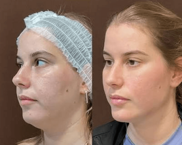Hifu 25D 360 MAX: eliminación de papada y radiofrecuencia de papada y cuello (flacidez)