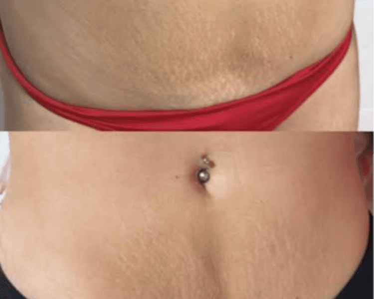 Hifu 25D 360 Rostro, Cuello y Abdomen