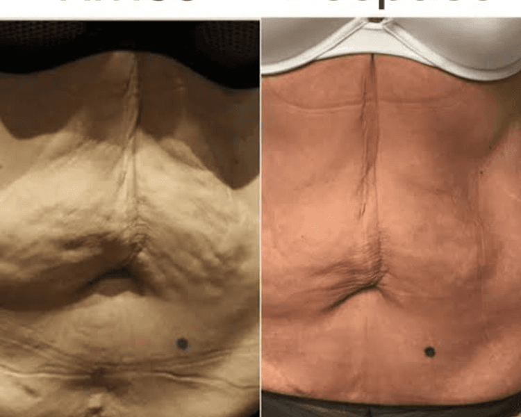 Liposonix + radiofrecuencia abdomen completo mas flancos