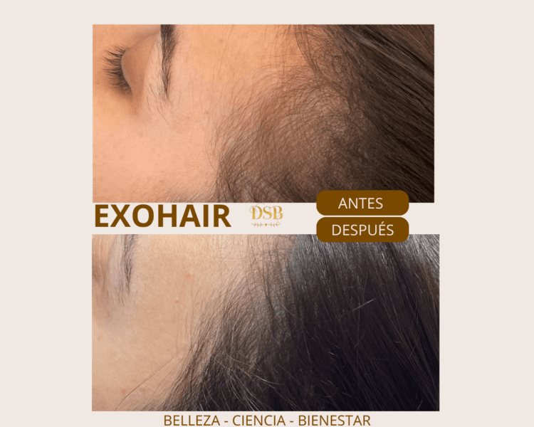 ExoHair® | Recuperación y Fortalecimiento Capilar