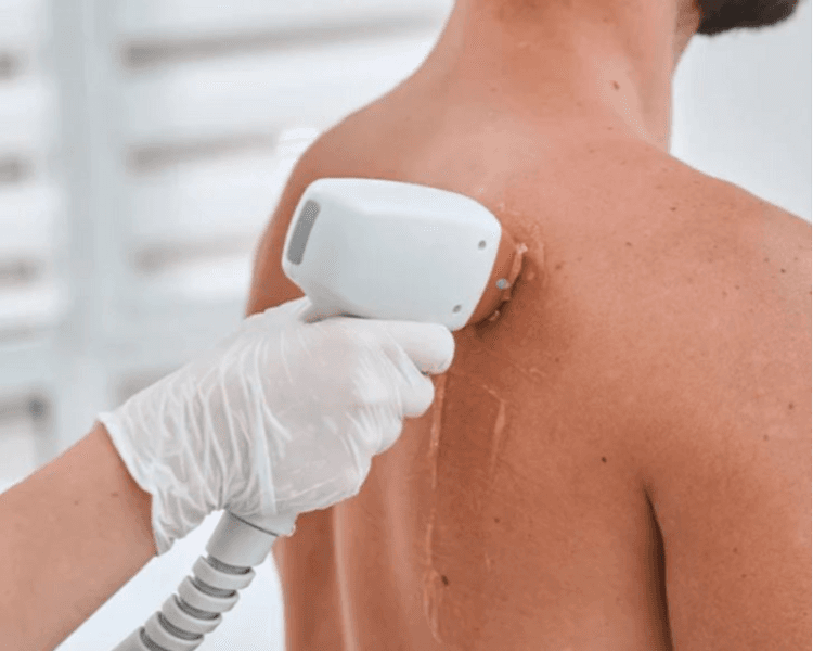 Depilación Láser Hombre: Espalda Completa (6 sesiones)