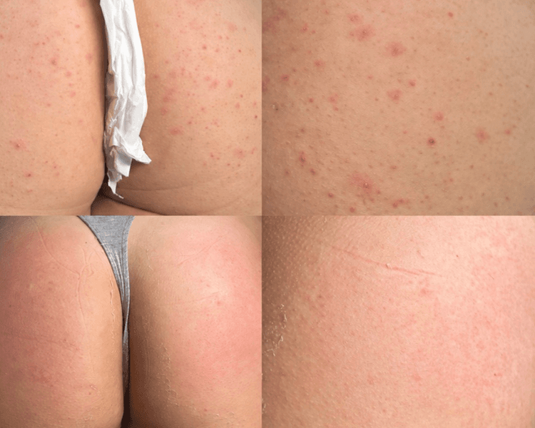 PEELING DE ALGAS GLÚTEOS ✨