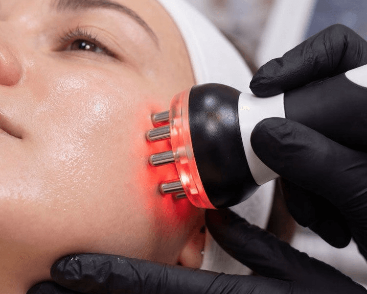 4 Sesiones - Radiofrecuencia Facial