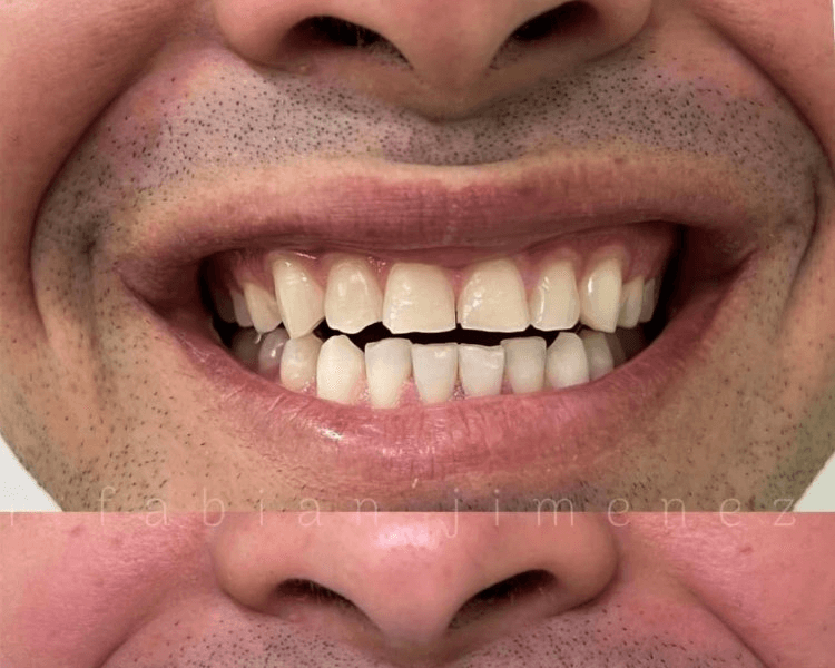 DISEÑO DE SONRISA