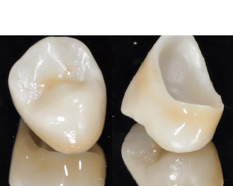 CORONA EN ZIRCONIO