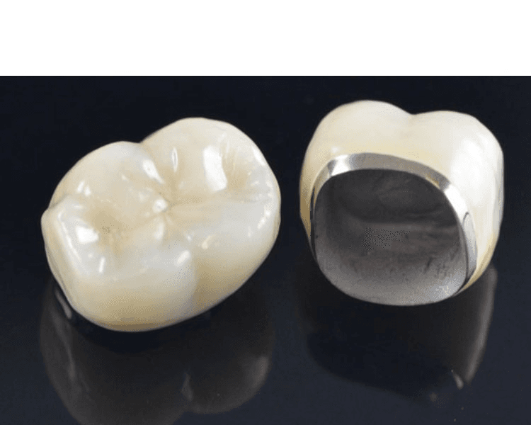 CORONA METAL CERAMICA UND