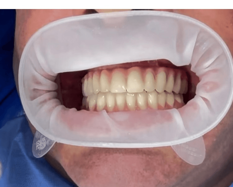 SISTEMA DE IMPLANTES