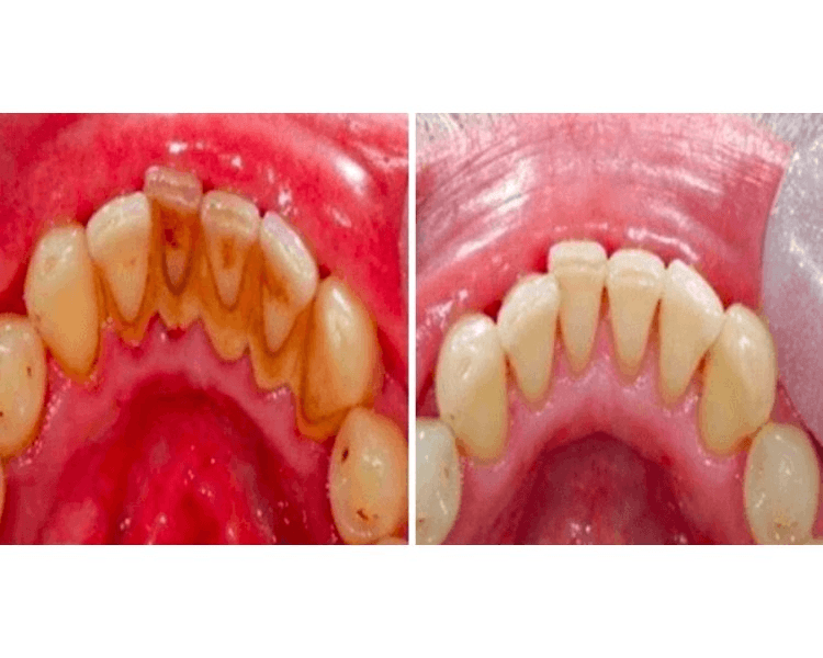 DETARTRAJE + PROFILAXIS
