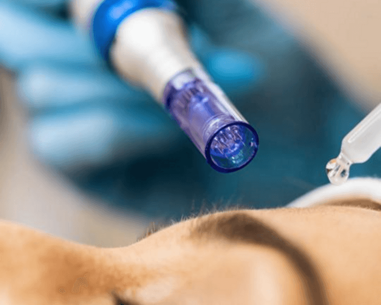 Limpieza de cutis profunda con dermapen (deep facial cleansing and microneedling) ( EFECTIVO $66.000)