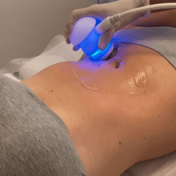 Ultracavitacion ( EFECTIVO $45.000)