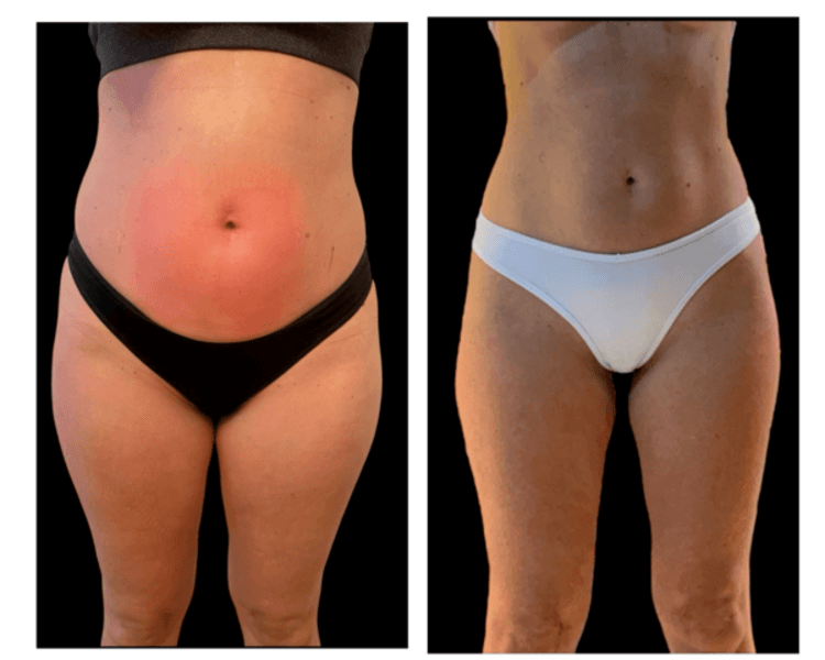 Pack Reductor I (4 sesiones de Ultracavitación o Radiofrecuencia + 4 sesiones de masaje reductor con llevadas de drenaje+ 4 mascaras )