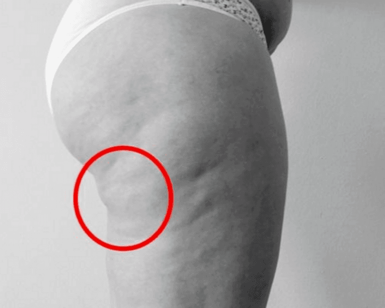 Trat. Celulitis en zona bajo glúteo