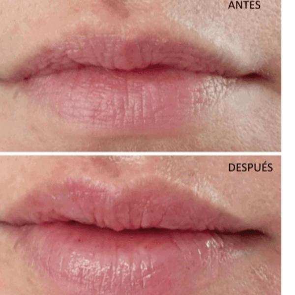 Hidratación de Labios con Ácido Hialurónico Reticulado (Incluye el bálsamo labial de regalo)