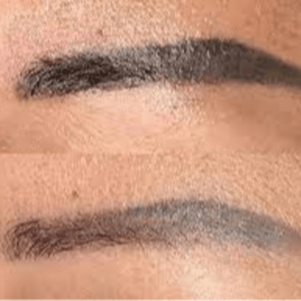 REMOCIÓN DE TATUAJES DE CEJAS 5 SESIONES