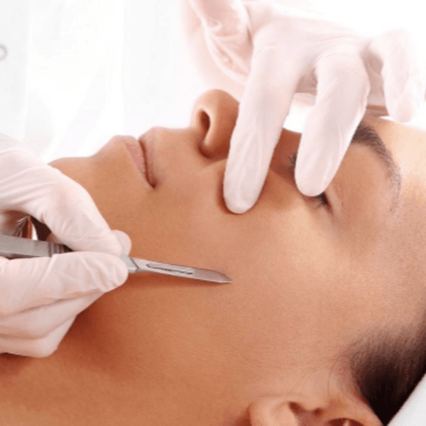 EXFOLIACION DERMAPLANING + Extracción de puntos negros de nariz + Mascarilla crema+ Protector solar.