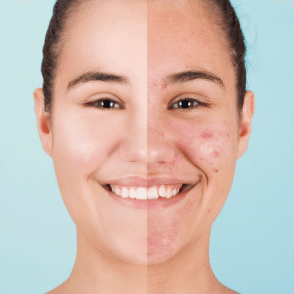 FOTOTERAPIA ACNE FACIAL