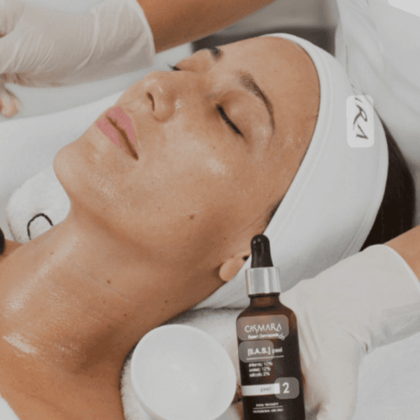 Peeling químico casmara (1sesion)
