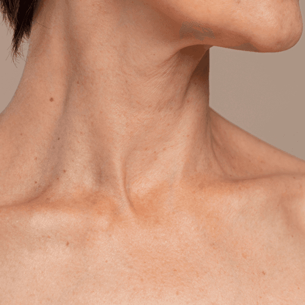 Hifu Cuello y papada (2S)