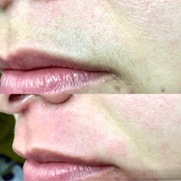 Depilación Facial Completa